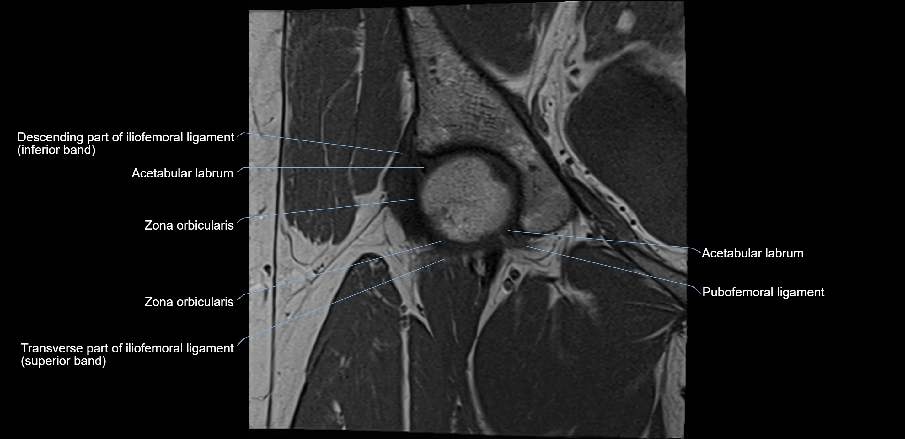 MRI Hip ligaments coronal cross sectional anatomy 3T  radiology  image-img-00001-00006.webp